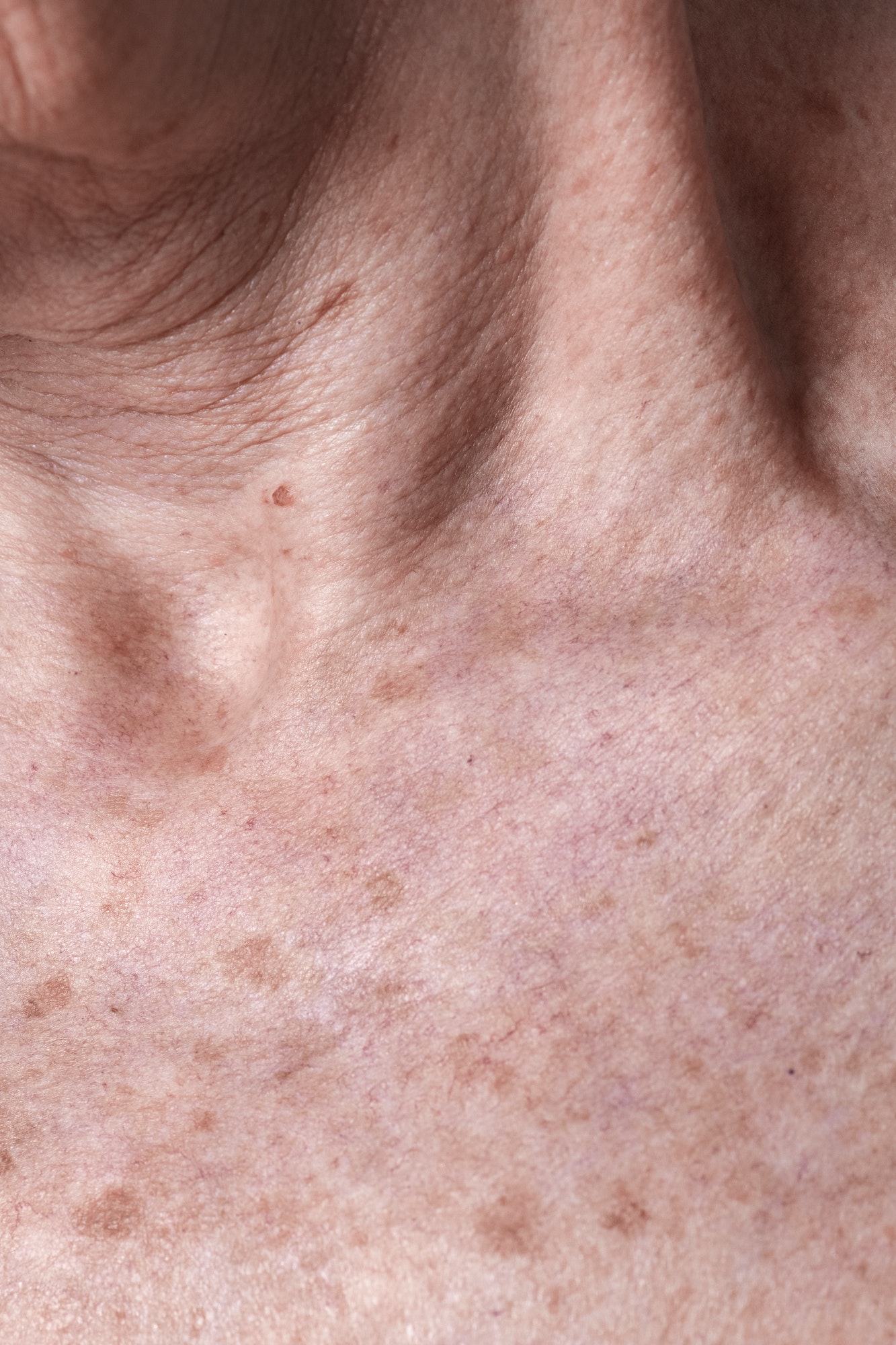 Aging female skin with melasma spots