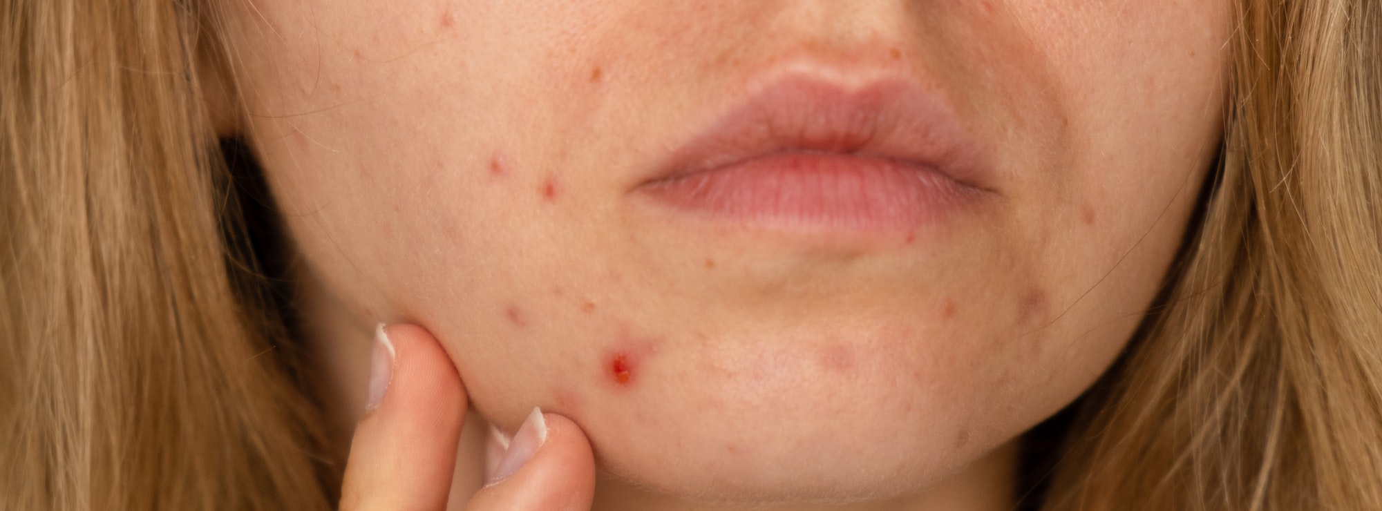 Unrecognizable woman showing her acne on face. Banner Close-up acne on woman's face with rash skin