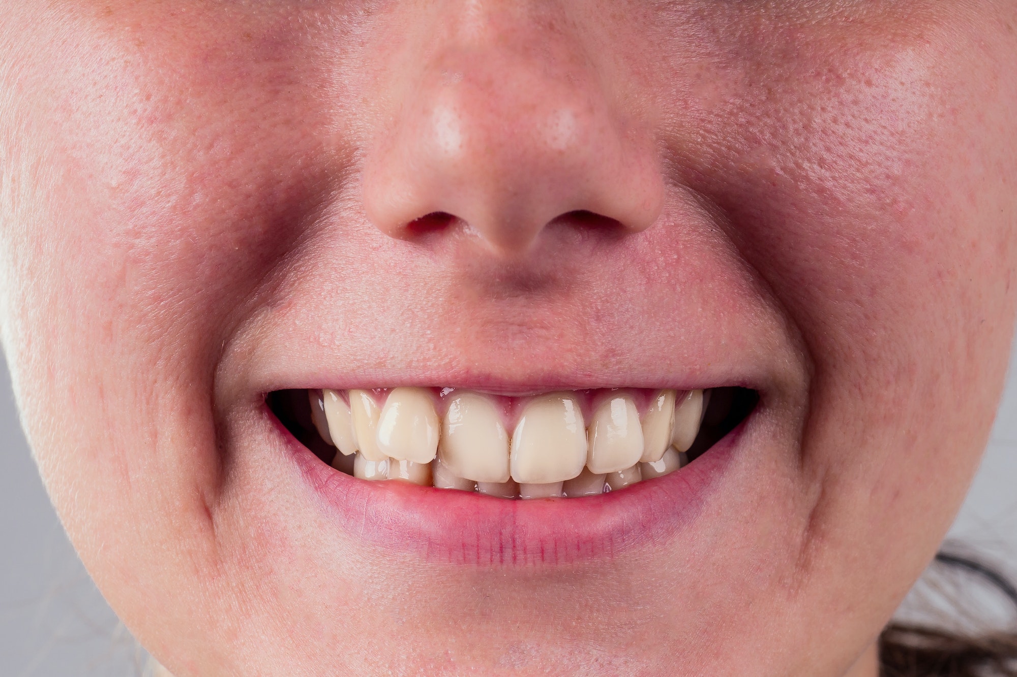 white smile with curvature tooth of young woman on whitw background in studio